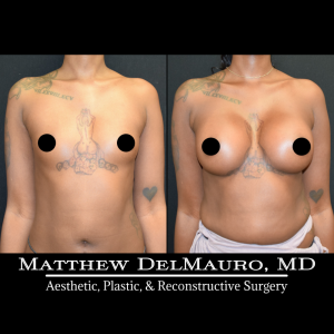 Before-After-3.5-Months-–-Breast-Augmentation-Silicone2