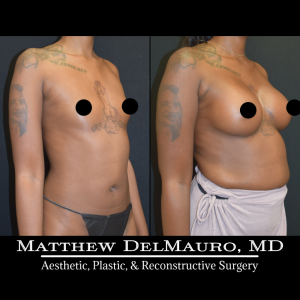 Before-After-3.5-Months-–-Breast-Augmentation-Silicone3