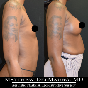 Before-After-3.5-Months-–-Breast-Augmentation-Silicone4