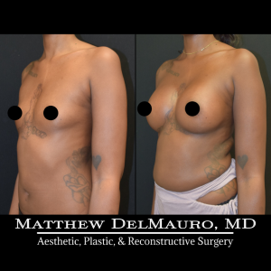 Before-After-3.5-Months-–-Breast-Augmentation-Silicone5