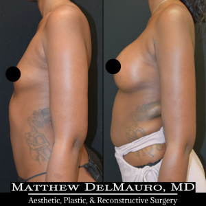 Before-After-3.5-Months-–-Breast-Augmentation-Silicone6