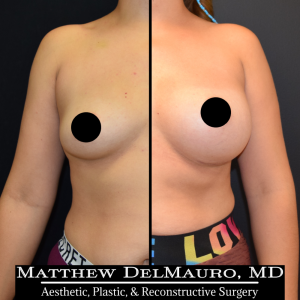 Before-After-4-Months-–-Breast-Augmentation-Silicone1