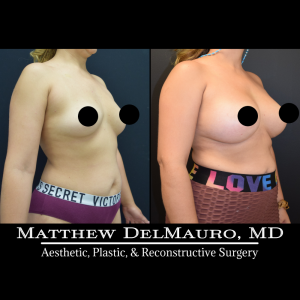 Before-After-4-Months-–-Breast-Augmentation-Silicone2