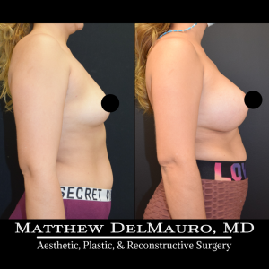 Before-After-4-Months-–-Breast-Augmentation-Silicone3