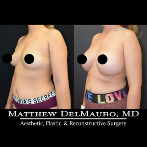 Before-After-4-Months-–-Breast-Augmentation-Silicone4