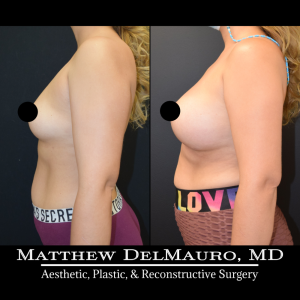 Before-After-4-Months-–-Breast-Augmentation-Silicone5