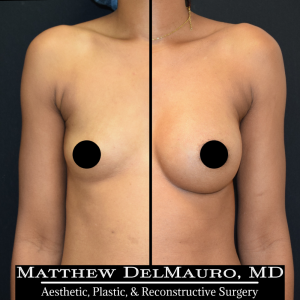 Before-After-4.25-Months-–-Breast-Augmentation-Silicone1