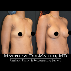 Before-After-4.25-Months-–-Breast-Augmentation-Silicone3