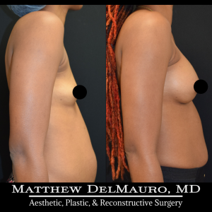 Before-After-4.25-Months-–-Breast-Augmentation-Silicone4