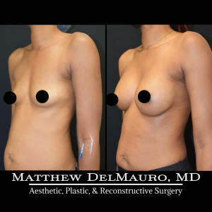 Before-After-4.25-Months-–-Breast-Augmentation-Silicone5