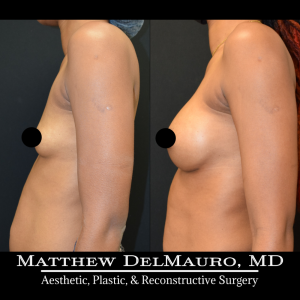 Before-After-4.25-Months-–-Breast-Augmentation-Silicone6