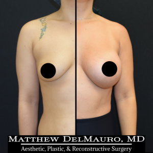 Before-After-4.5-Months-–-Breast-Augmentation-Silicone1