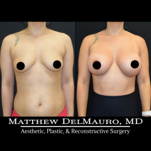 Before-After-4.5-Months-–-Breast-Augmentation-Silicone2