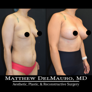 Before-After-4.5-Months-–-Breast-Augmentation-Silicone3