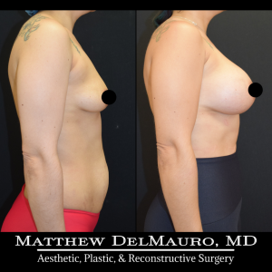 Before-After-4.5-Months-–-Breast-Augmentation-Silicone4