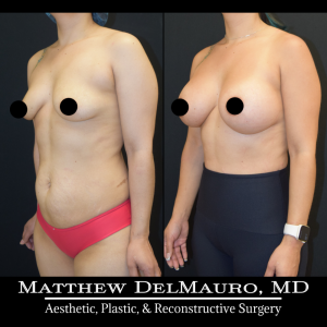 Before-After-4.5-Months-–-Breast-Augmentation-Silicone5