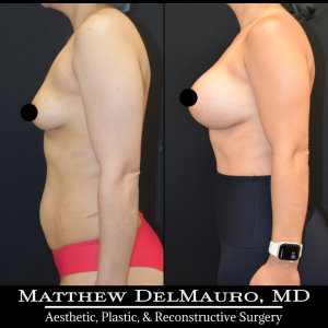 Before-After-4.5-Months-–-Breast-Augmentation-Silicone6