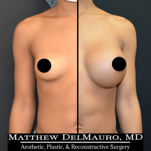 Before-After-5-Months-–-Breast-Augmentation-Silicone1