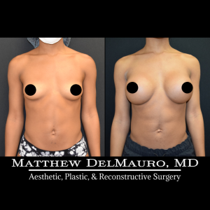 Before-After-5-Months-–-Breast-Augmentation-Silicone2