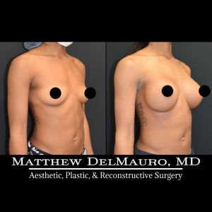 Before-After-5-Months-–-Breast-Augmentation-Silicone3