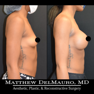 Before-After-5-Months-–-Breast-Augmentation-Silicone4