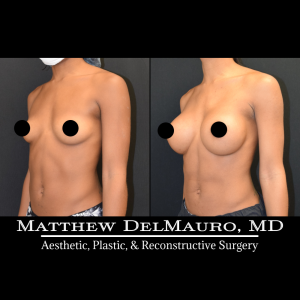 Before-After-5-Months-–-Breast-Augmentation-Silicone5