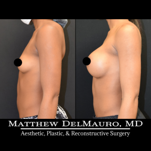 Before-After-5-Months-–-Breast-Augmentation-Silicone6