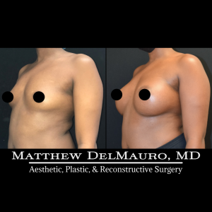 Before-After-6-Months-–-Breast-Augmentation-Silicone1