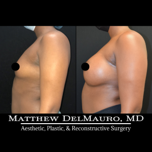 Before-After-6-Months-–-Breast-Augmentation-Silicone2