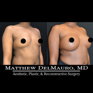 Before-After-6-Months-–-Breast-Augmentation-Silicone3