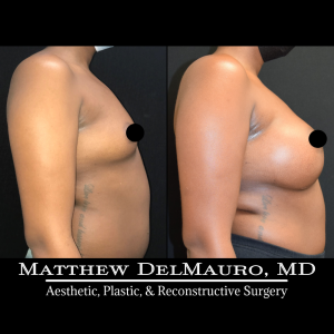 Before-After-6-Months-–-Breast-Augmentation-Silicone4