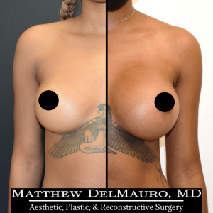 Before-After-8.5-Months-–-Breast-Augmentation-Silicone1