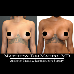 Before-After-8.5-Months-–-Breast-Augmentation-Silicone2