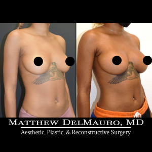 Before-After-8.5-Months-–-Breast-Augmentation-Silicone3