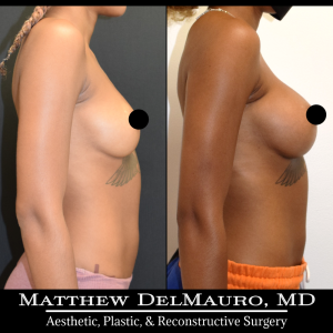 Before-After-8.5-Months-–-Breast-Augmentation-Silicone4