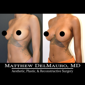 Before-After-8.5-Months-–-Breast-Augmentation-Silicone5