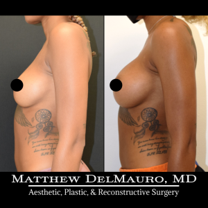 Before-After-8.5-Months-–-Breast-Augmentation-Silicone6