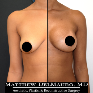 Before-After-Preoperative-–-Breast-Augmentation-Silicone1