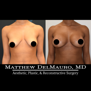 Before-After-Preoperative-–-Breast-Augmentation-Silicone2