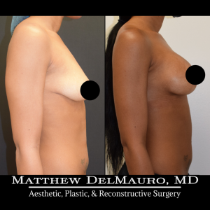 Before-After-Preoperative-–-Breast-Augmentation-Silicone3