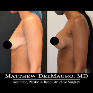 Before-After-Preoperative-–-Breast-Augmentation-Silicone4