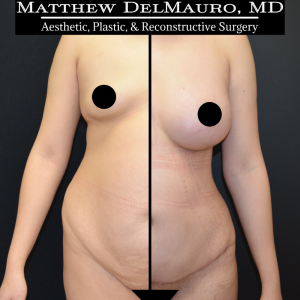 P10-Before-After-3-Months-–-Breast-Augmentation-Silicone-Lipo-Abdominoplasty1