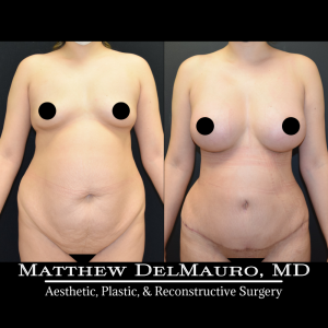 P10-Before-After-3-Months-–-Breast-Augmentation-Silicone-Lipo-Abdominoplasty3