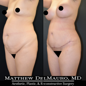 P10-Before-After-3-Months-–-Breast-Augmentation-Silicone-Lipo-Abdominoplasty4