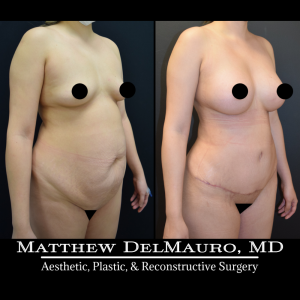 P10-Before-After-3-Months-–-Breast-Augmentation-Silicone-Lipo-Abdominoplasty5