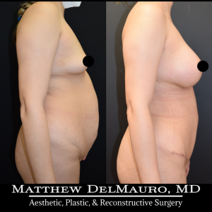 P10-Before-After-3-Months-–-Breast-Augmentation-Silicone-Lipo-Abdominoplasty6