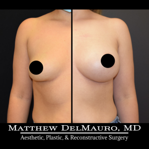 P12-Before-After-3.5-Months-–-Breast-Augmentation-Silicone1