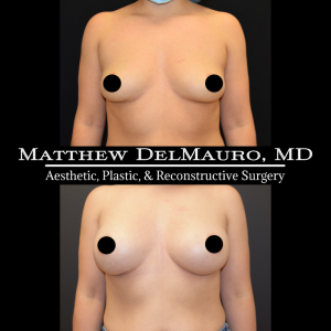 P12-Before-After-3.5-Months-–-Breast-Augmentation-Silicone2