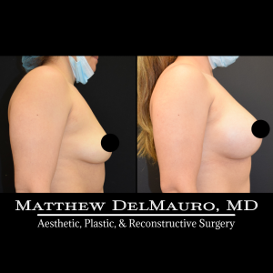 P12-Before-After-3.5-Months-–-Breast-Augmentation-Silicone3