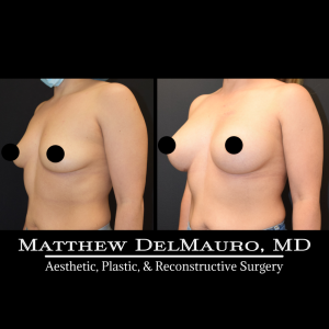 P12-Before-After-3.5-Months-–-Breast-Augmentation-Silicone4